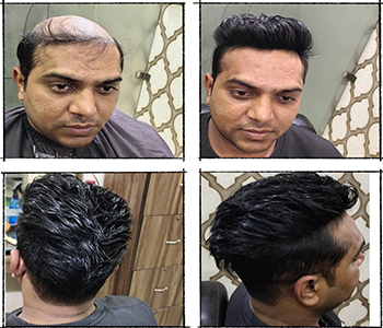 Men Hair Wigs in Hyderabad 9951223066  WIGS DESIGNS  Men Hair Wigs in  Jagadgiri Gutta